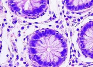 Genetic Information In The Cells That Form Tumors Dictates Whether They Metastasize Or Not