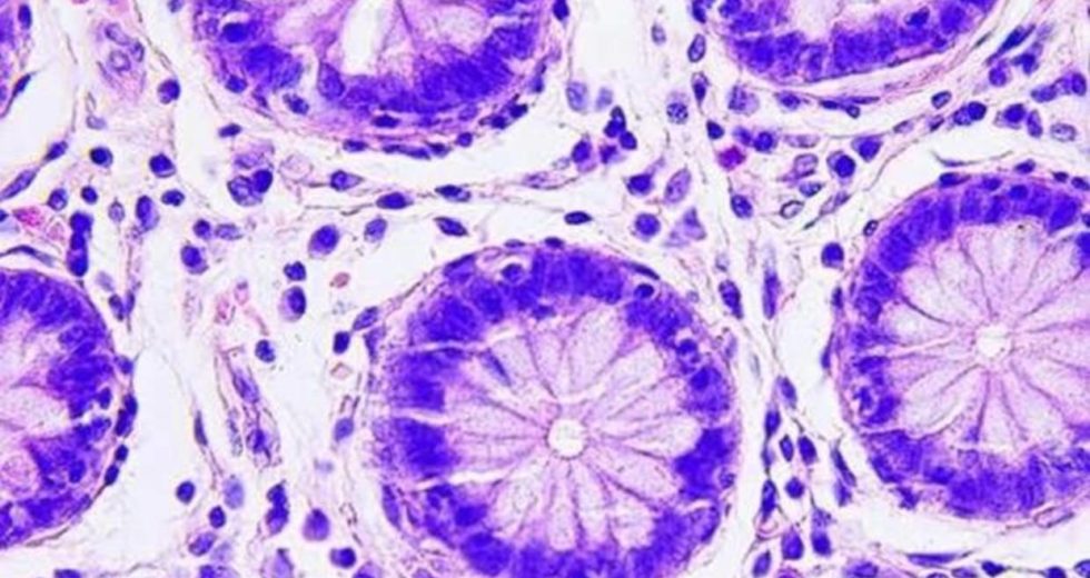 Genetic Information In The Cells That Form Tumors Dictates Whether They Metastasize Or Not