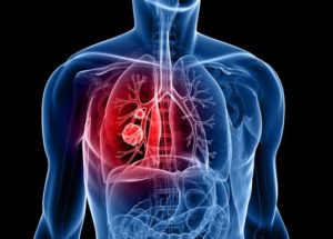 Lung Cancer Incidence In Young Women Is Higher In The US And Is Not Related To Smoking