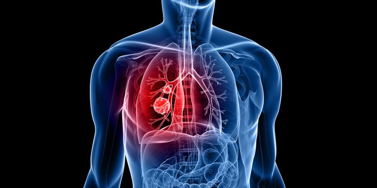 Lung Cancer Incidence In Young Women Is Higher In The US And Is Not Related To Smoking