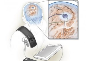 Self-Adaptive Brain Implant Might Reduce Parkinson’s Disease Motor Symptoms