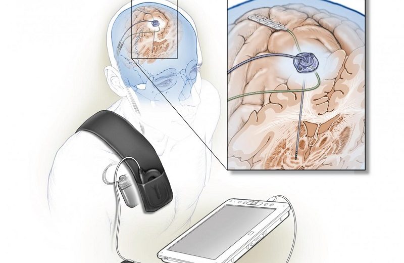 Self-Adaptive Brain Implant Might Reduce Parkinson’s Disease Motor Symptoms