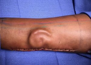 A US Soldier Gets A New Ear After It Was Reconstructed On The Patient’s Forearm