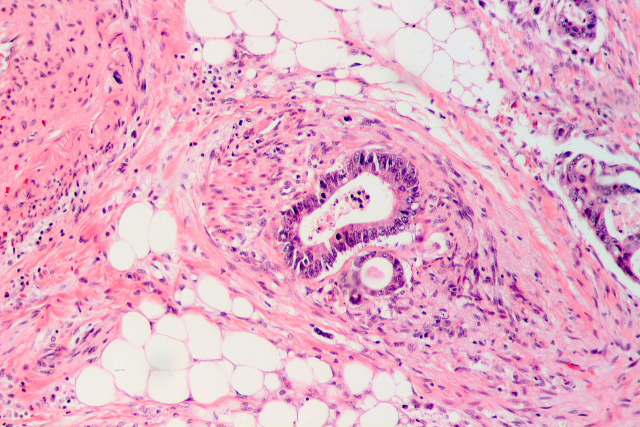 The Strange Correlation Between Vitamin D and Colorectal Cancer
