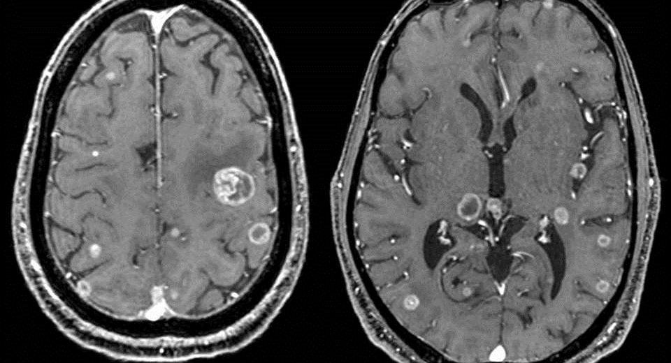 Brain Metastases Treatment, A STAT3 Gene Inhibitor, Discovered By Spanish Researchers