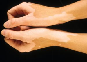 Vitiligo Research With Promising Results In Mice Soon To Start Clinical Trials