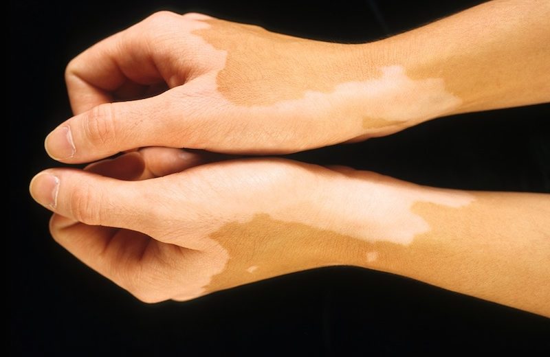 Vitiligo Research With Promising Results In Mice Soon To Start Clinical Trials