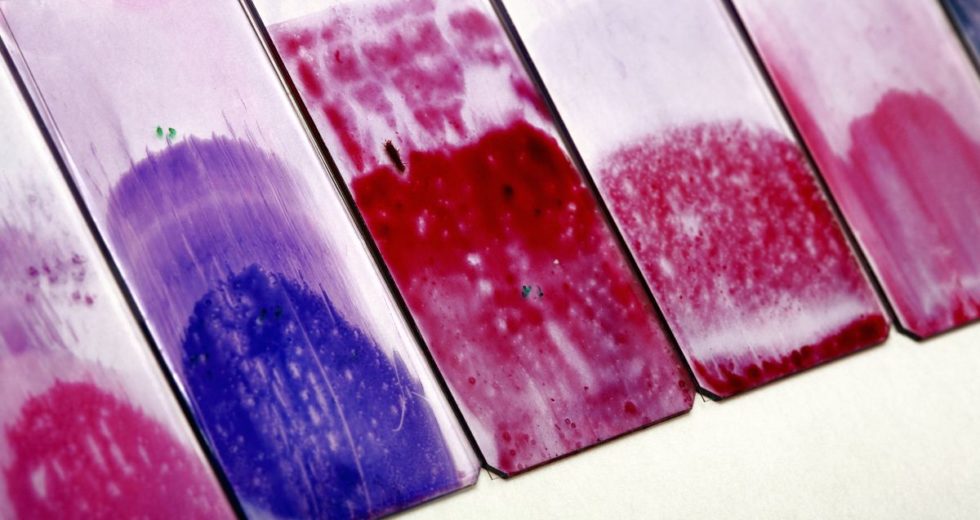 Cervical Cancer Screening will Include More Options