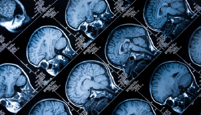 A 10-Year-Old Boy Nearly Fully Recovered After Doctors Cut Out One-Sixth Of His Brain