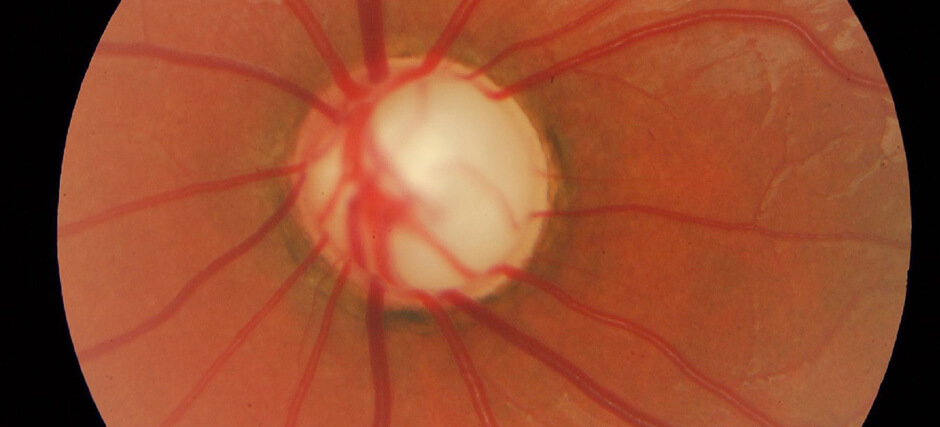 Glaucoma Might Be An Autoimmune Diesease, A New Study Revealed