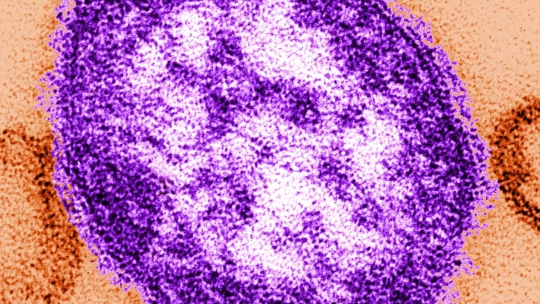Measles Concerns Surrounding The New Westminster Outdoor Pool As Some Reports Emerged