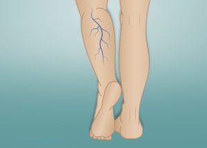 Varicose Veins Prevention And Treatment With Physical Exercise Is Possible
