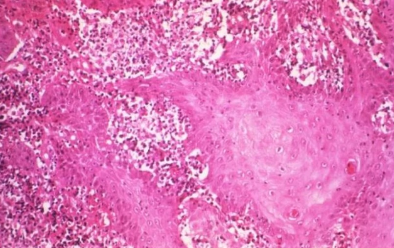 Sexually Transmitted Disease From The Tropics Causes Genitals To Rot – First Cases Recorded In The UK