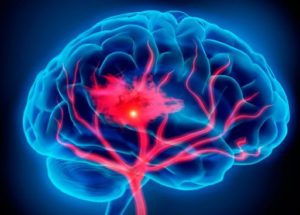 Strokes And Heart Attacks Double The Risks Of Dementia