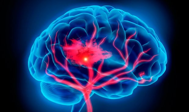 Strokes And Heart Attacks Double The Risks Of Dementia