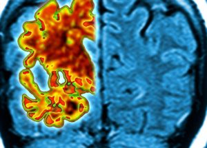 The Risk of Developing Dementia Could Increase if You Have This Common Habit