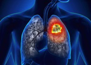 Lung Cancer Has A Significant Direct Economic Impact Across Latin America, a British Study Revealed