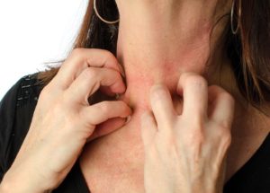 Woman Experiences Weird Allergic Reaction to Antibiotics