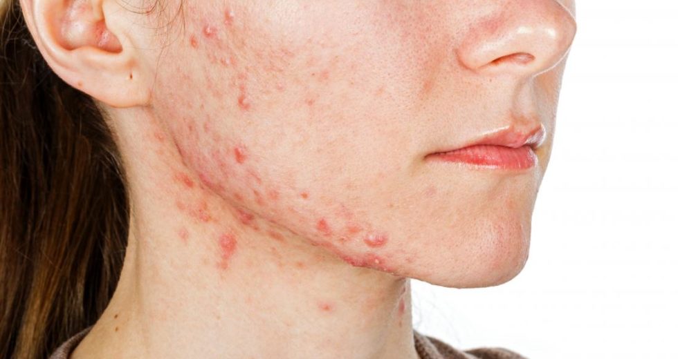A Working Acne Vaccine Is Finally Possible Against The Most Common P. Acnes Bacteria Strains In Humans