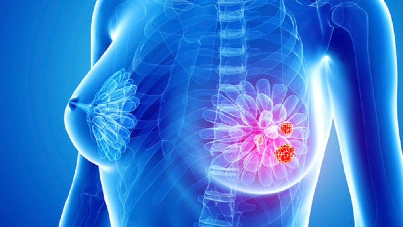 American and Canadian Researchers Discovered New DNA Mutations Involved in Breast Cancer
