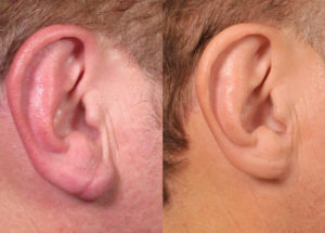 Indian Doctor Claims That 95% of The People With Ear Crease Have Heart Disease