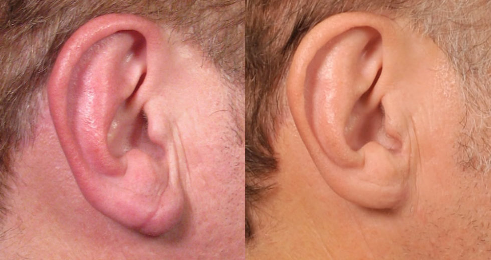 Indian Doctor Claims That 95% of The People With Ear Crease Have Heart Disease