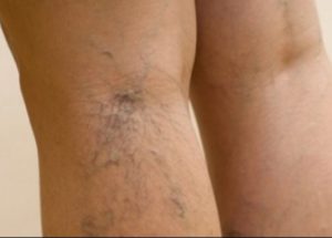 Your Height Might Increase the Risks of Varicose Veins