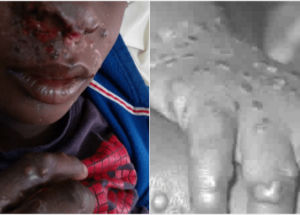 Public Health Officials Confirmed The Third Monkeypox Virus Case Across The UK