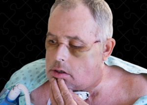 The First Canadian Face Transplant Concluded Successfully