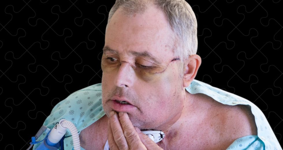 The First Canadian Face Transplant Concluded Successfully