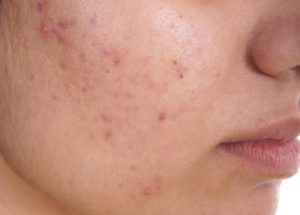 8 Simple Methods For Treating Acne At Home