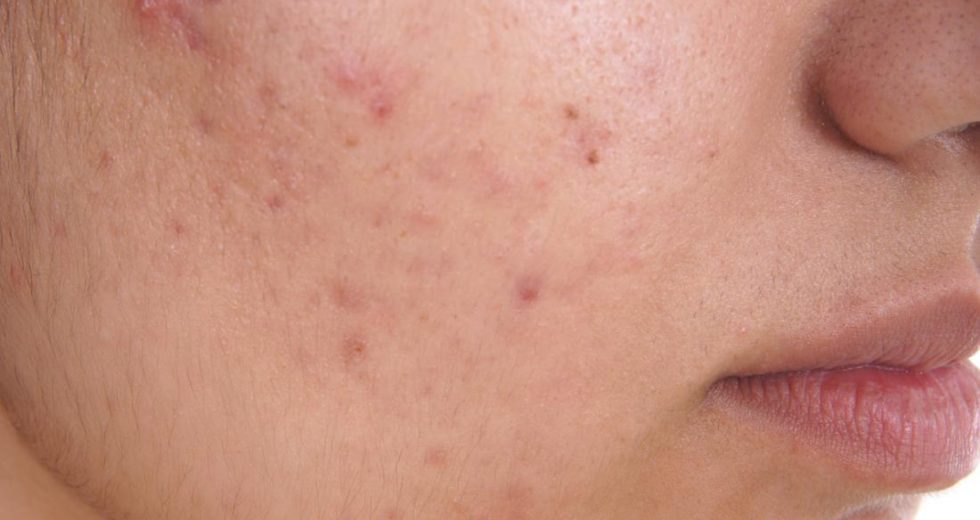 8 Simple Methods For Treating Acne At Home
