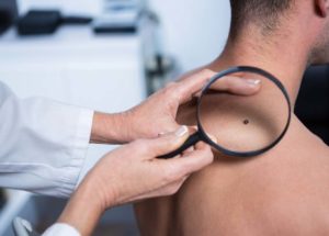 Men are More Prone to Skin Cancer