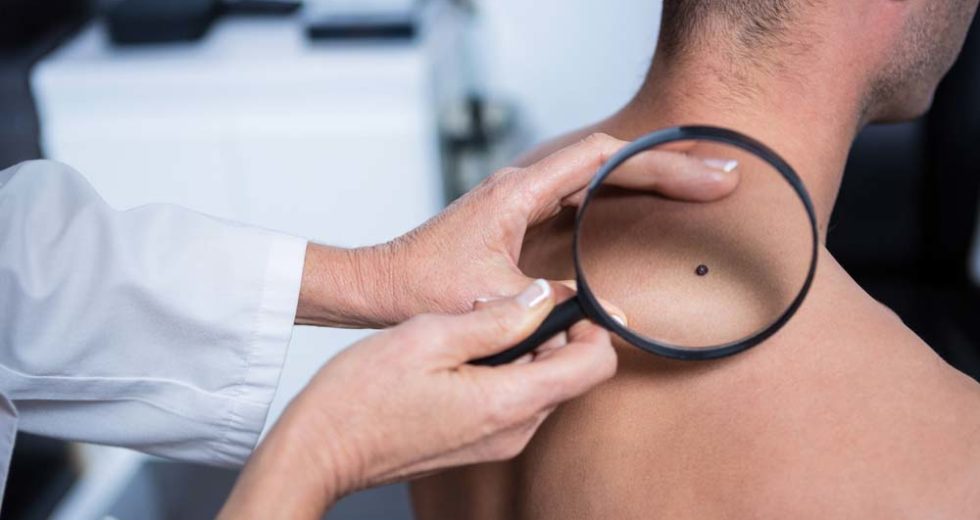 Men are More Prone to Skin Cancer