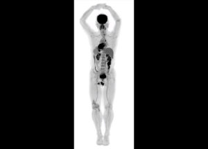 EXPLORER Is The Most Advanced PET Scanner, Being Able To Scan The Entire Human Body At Once