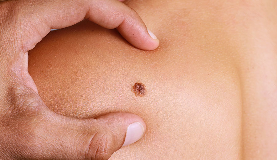 Skin Cancer Death Rates Are On The Rise, According To A Recent Study