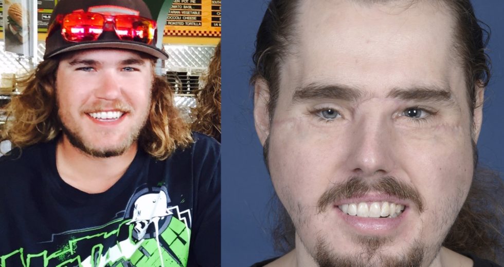 A Man who Received a Face Transplant Reveals his Appearance after a 25-hour Surgery