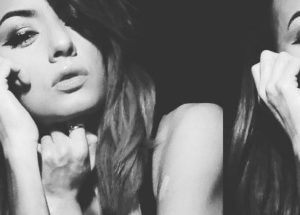 How Women Affected by Vitiligo Learned to Love Themselves