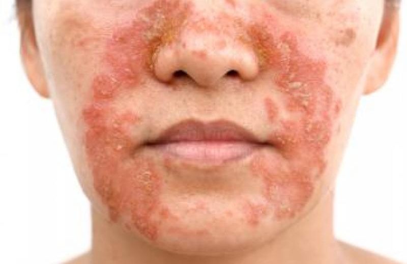 Atopic Dermatitis Linked To Increased Suicidal Behavior