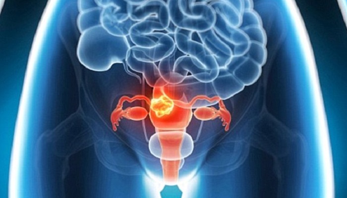 New Cervical Cancer Screening Method Is 100 Percent Accurate