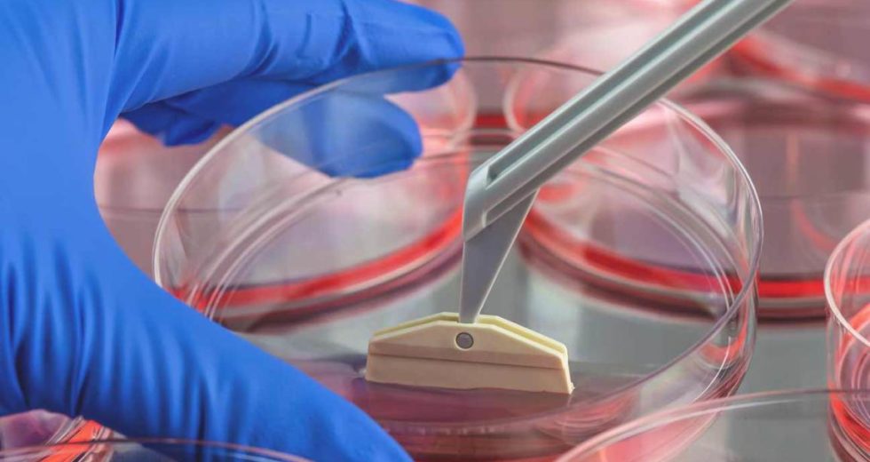 Patients with Multiple Sclerosis can be Helped by Stem Cell Therapy