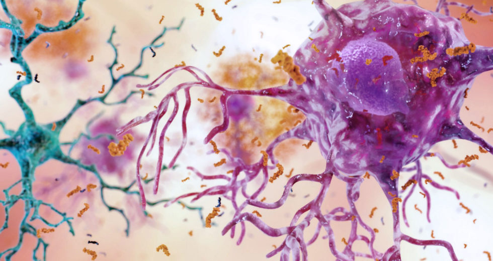 Physical Exercises Proved Beneficial In Slowing Alzheimer’s Disease Progression