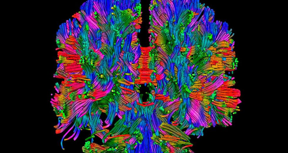 Brain Scans In Newborns Might Help Specialists Detect Autism