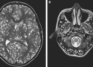 Teen Dead After Tapeworm Larvae Infestation in the Brain