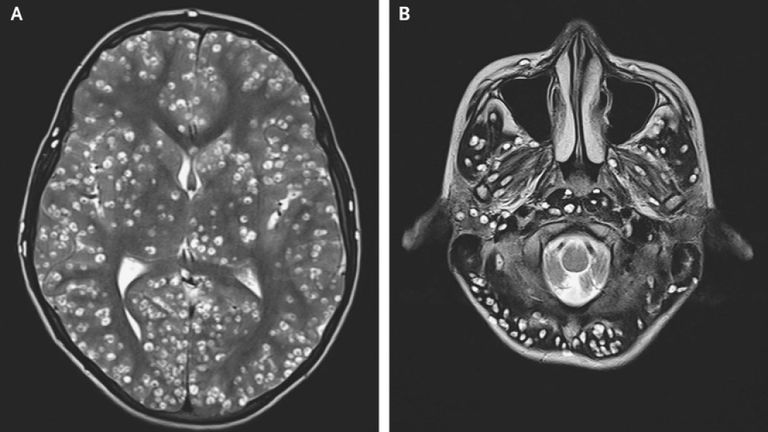 Teen Dead After Tapeworm Larvae Infestation in the Brain