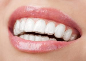 What to Expect From an Invisalign Treatment