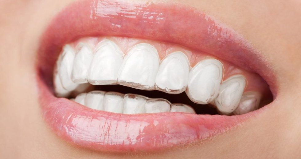 What to Expect From an Invisalign Treatment