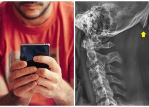 Excessive Smartphone Usage Promotes The Growth Of Horn-Like Bones In Young Adults