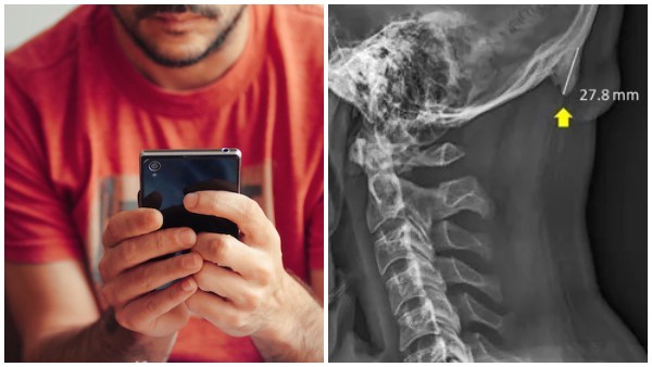 Excessive Smartphone Usage Promotes The Growth Of Horn-Like Bones In Young Adults