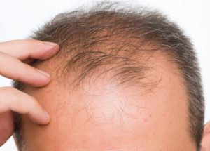 Researchers Reach a Major Milestone in the Search for a Baldness Cure